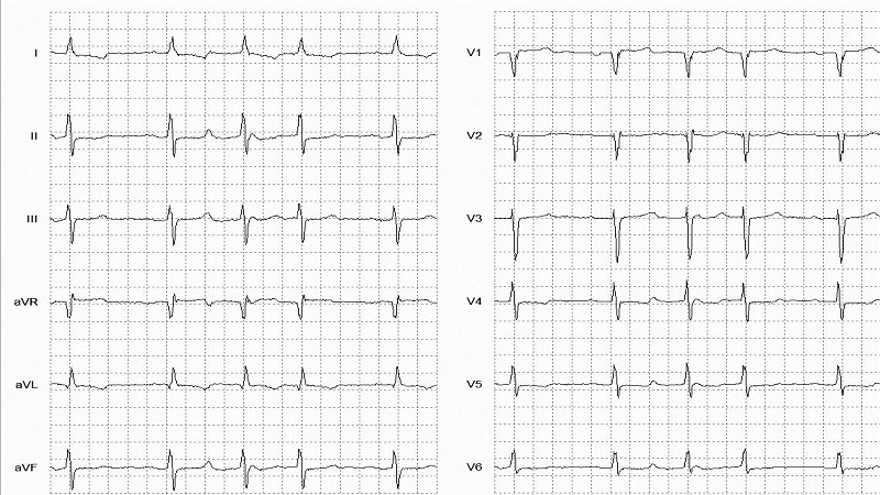 SVEB Couplets 12 Lead EKG